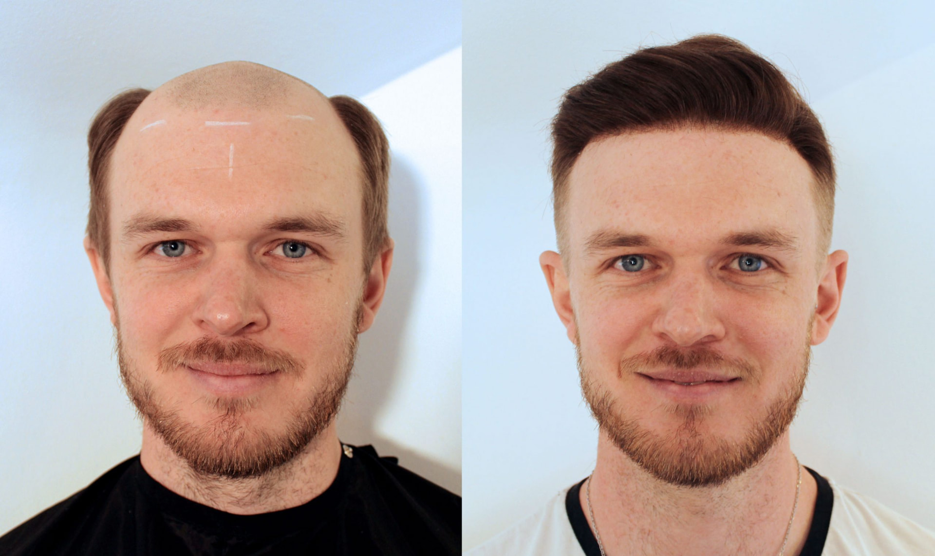 Front-facing before and after of a hair system fitting